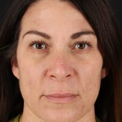 Lip Lift Before & After Patient #2133
