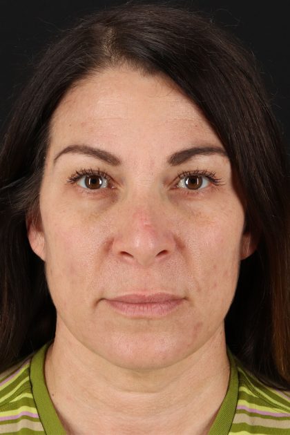 Lip Lift Before & After Patient #2133