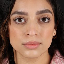 Rhinoplasty Before & After Patient #3269