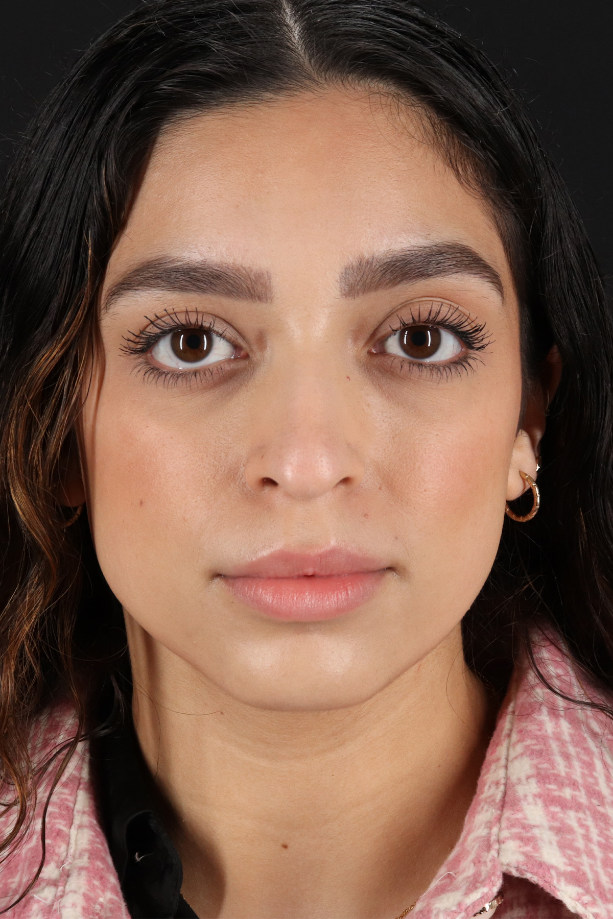 Rhinoplasty Before & After Patient #3269