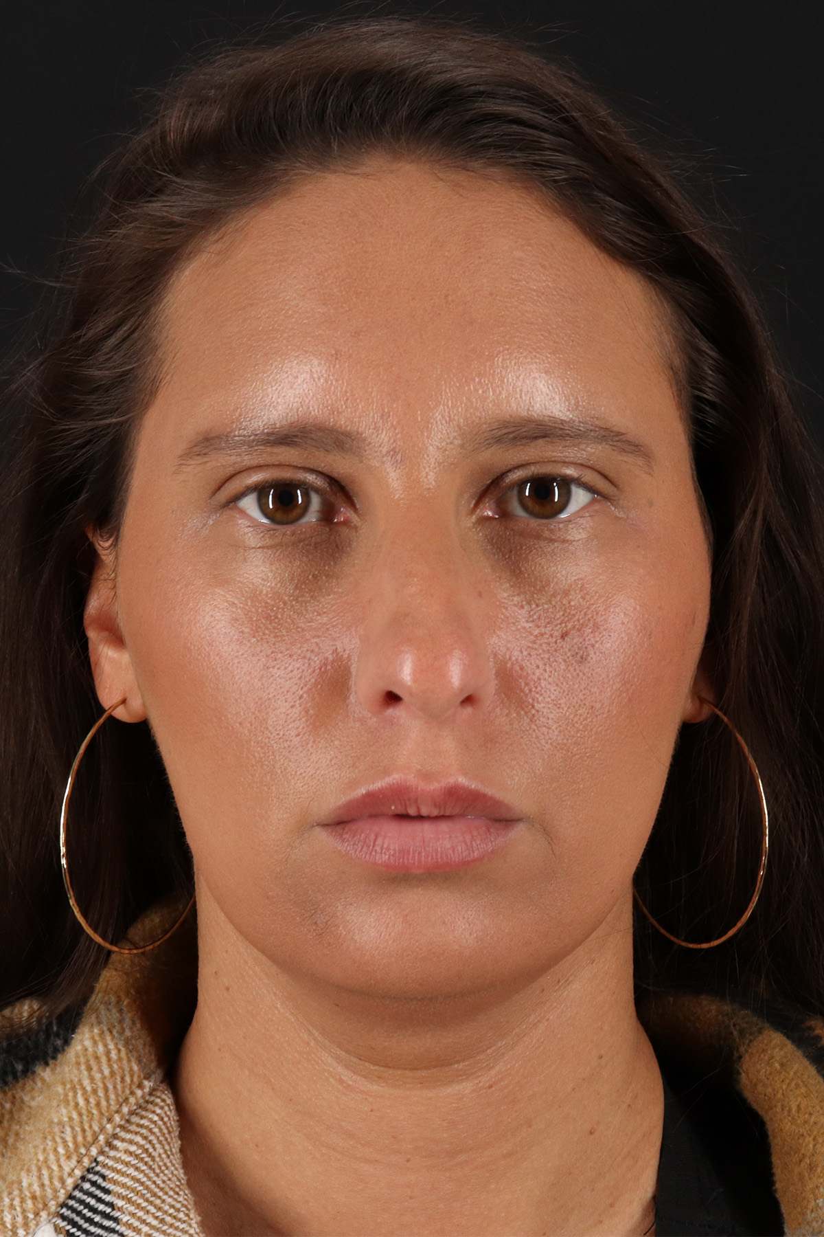 Neck Liposuction Before & After Patient #2719