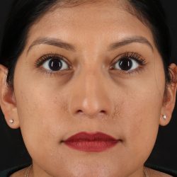 Rhinoplasty Before & After Patient #3181