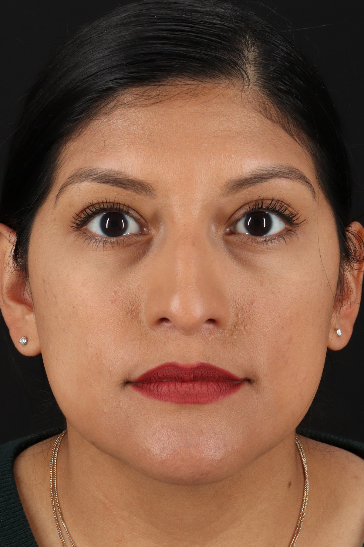 Rhinoplasty Before & After Patient #3181