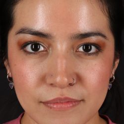 Liquid Rhinoplasty Before & After Patient #2265