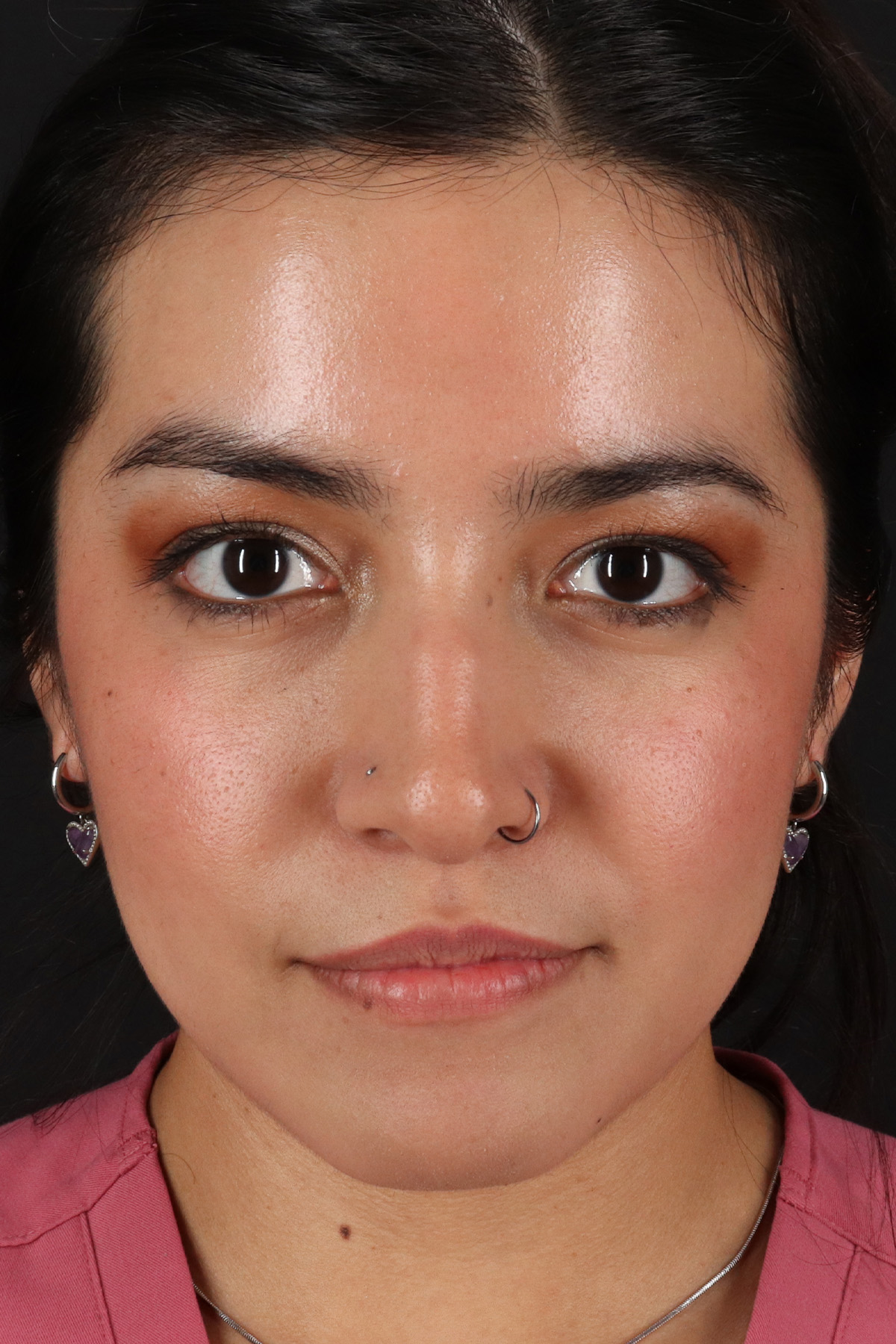Liquid Rhinoplasty Before & After Patient #2265