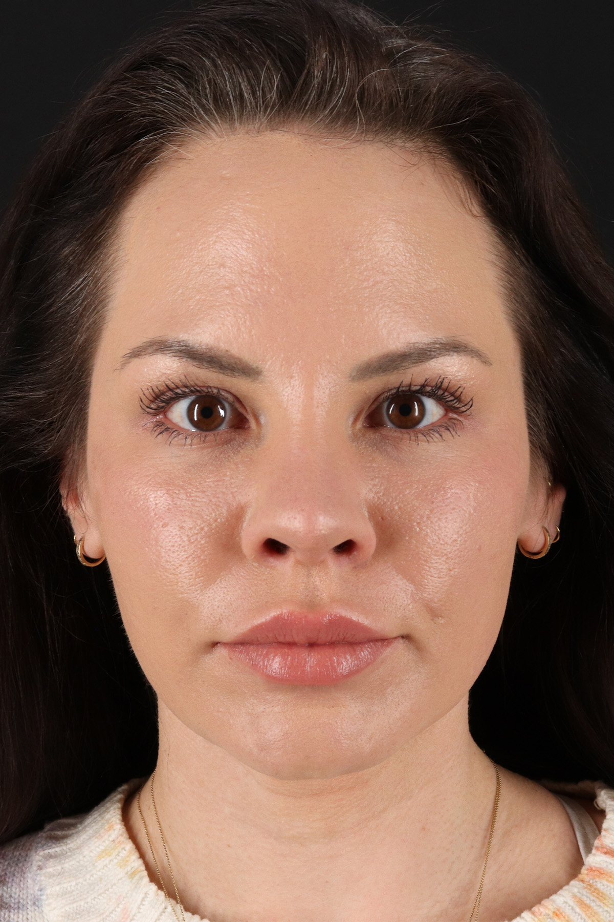 Buccal Fat Pad Before & After Patient #1425