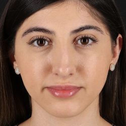 Rhinoplasty Before & After Patient #3214