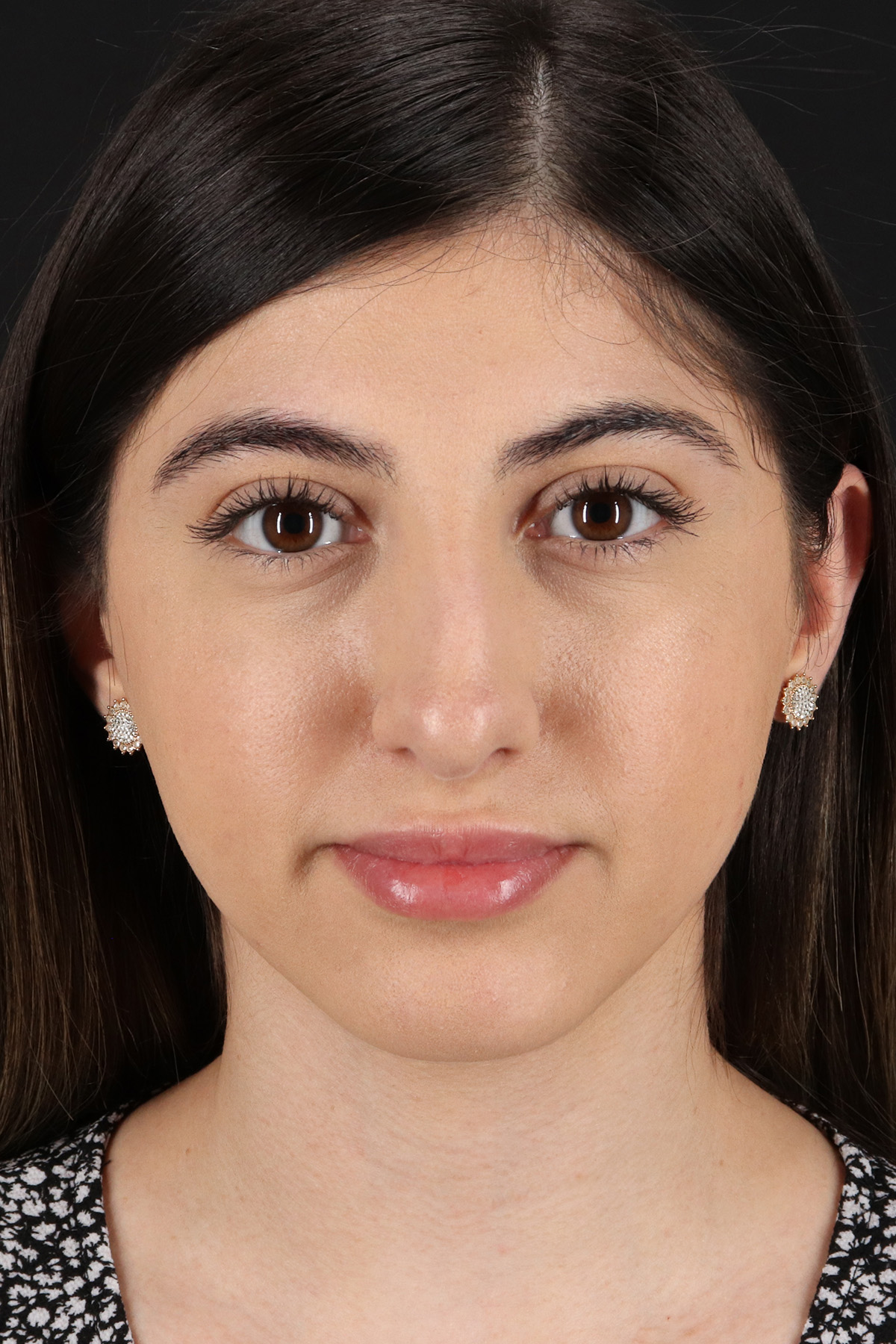Rhinoplasty Before & After Patient #3214