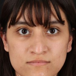 Rhinoplasty Before & After Patient #3038