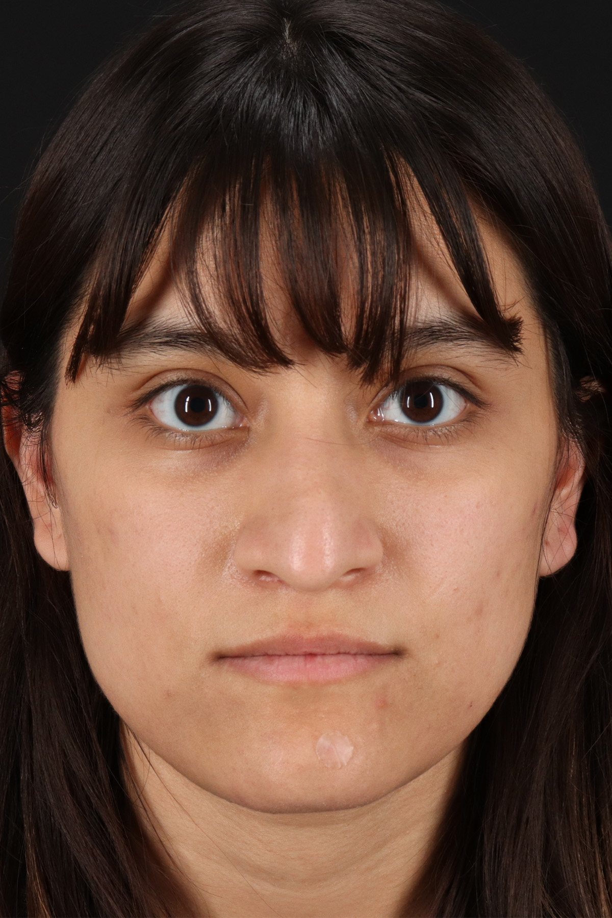 Rhinoplasty Before & After Patient #3038