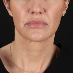 Facelift Before & After Patient #1921