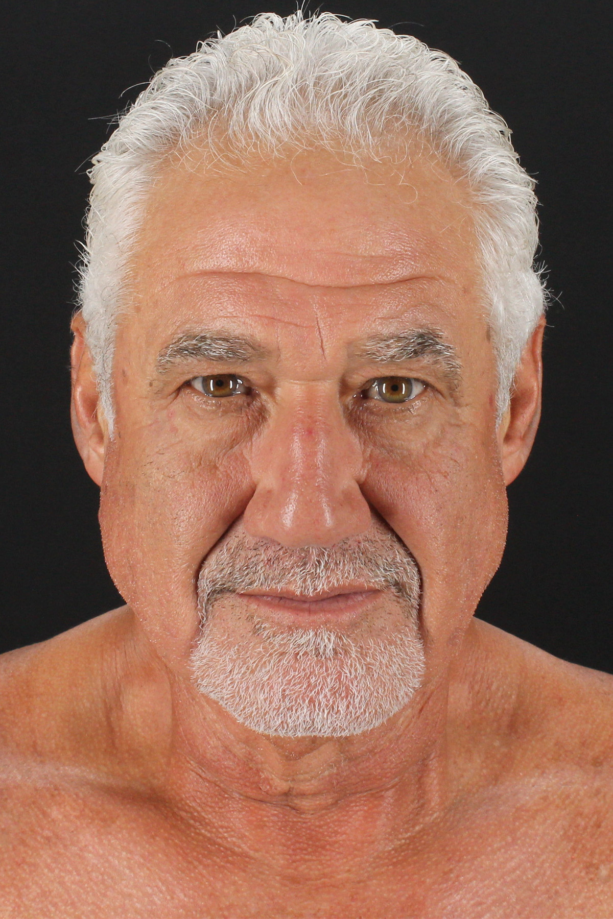 Lower Blepharoplasty Before & After Patient #2310