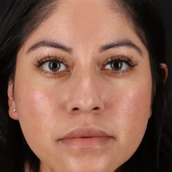 Liquid Rhinoplasty Before & After Patient #2290