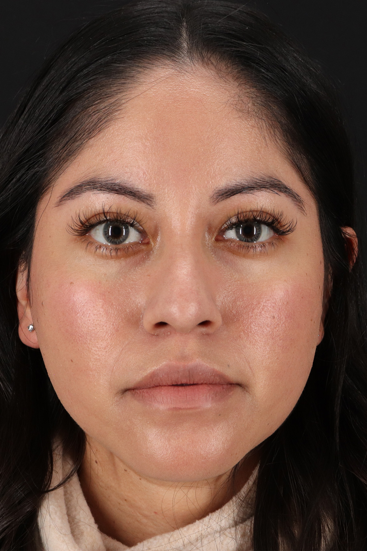 Liquid Rhinoplasty Before & After Patient #2290