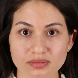 Rhinoplasty Before & After Patient #3236