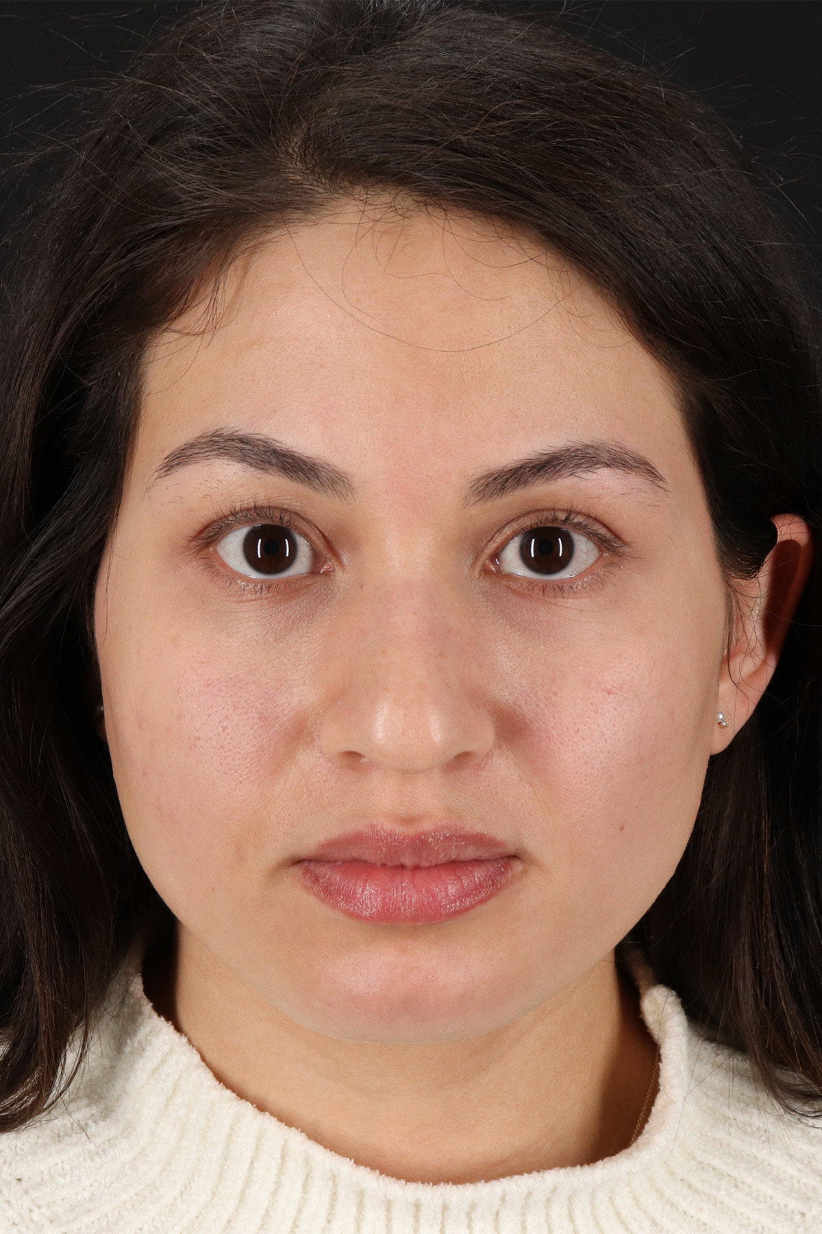 Rhinoplasty Before & After Patient #3236