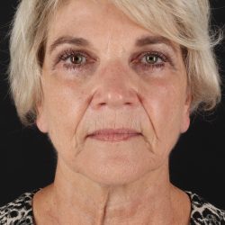 Facelift Before & After Patient #1943