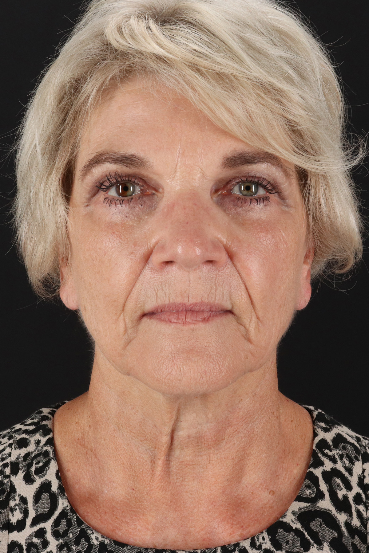Facelift Before & After Patient #1943