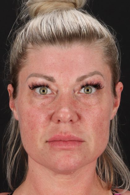 Fat Grafting To The Face Before & After Patient #2016