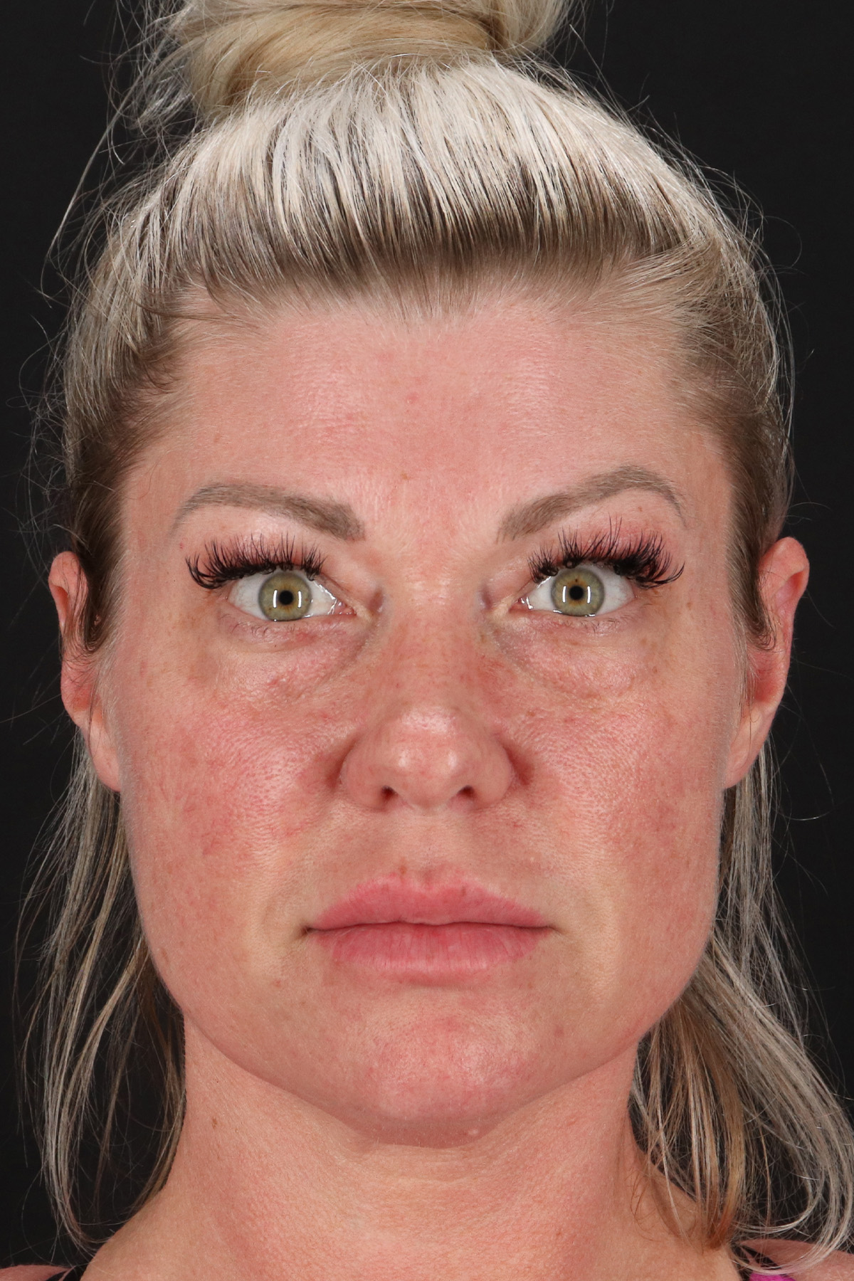 Fat Grafting To The Face Before & After Patient #2016
