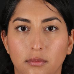 Liquid Rhinoplasty Before & After Patient #2232