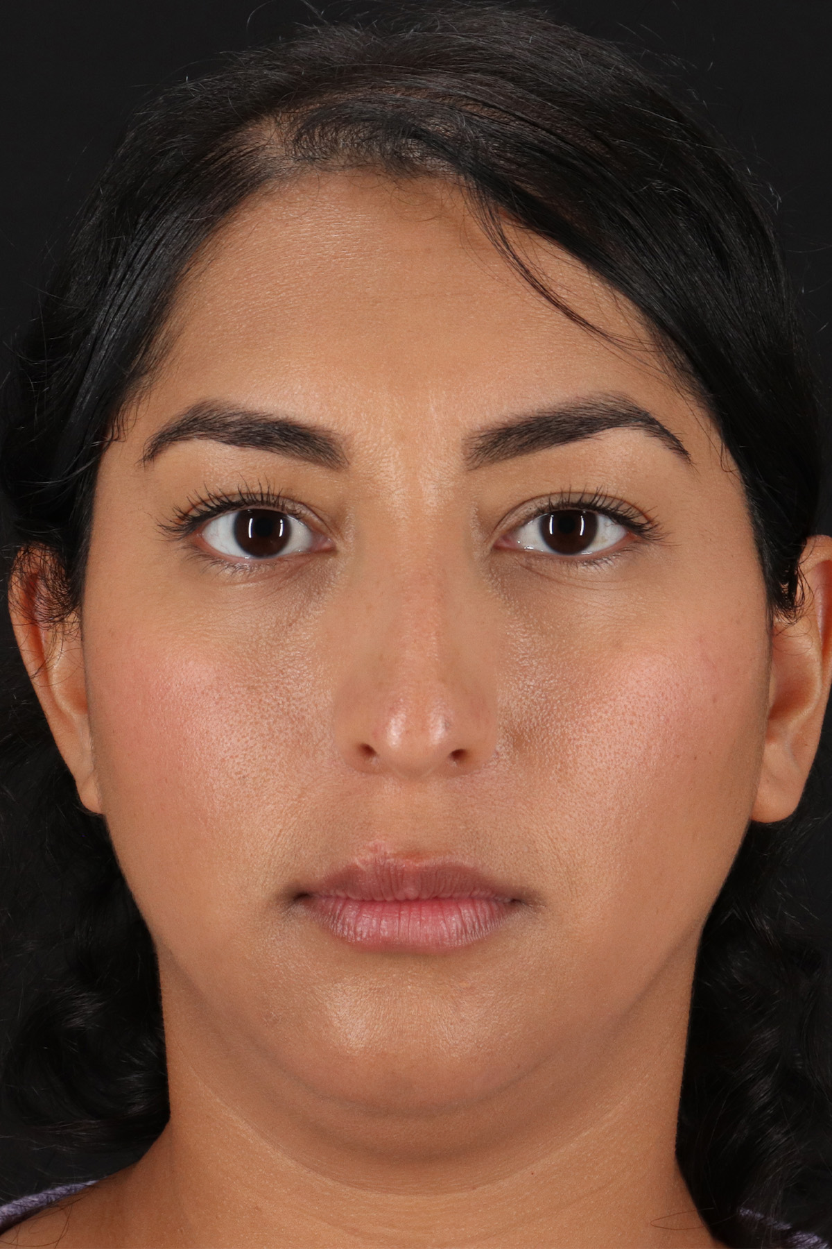 Liquid Rhinoplasty Before & After Patient #2232