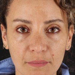 Liquid Rhinoplasty Before & After Patient #2276