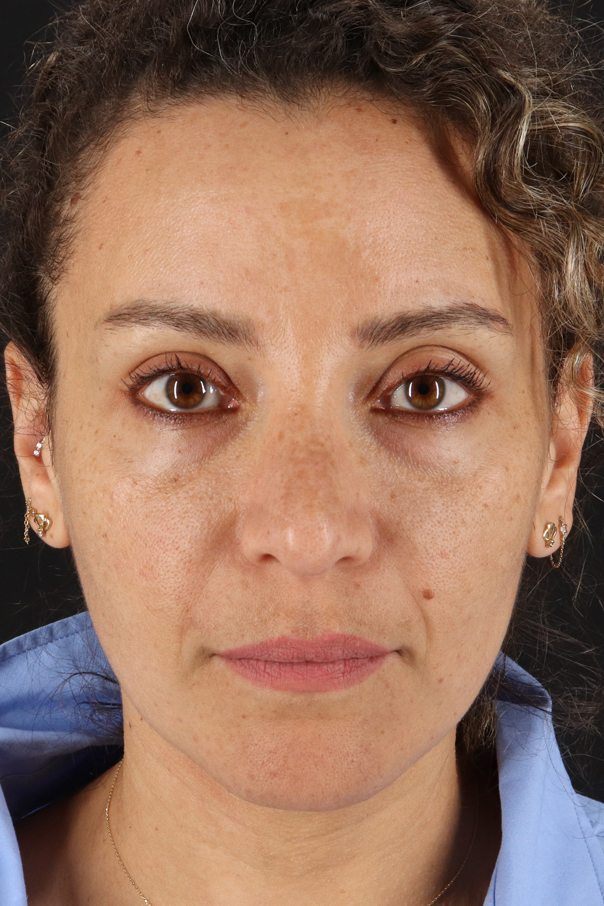 Liquid Rhinoplasty Before & After Patient #2276