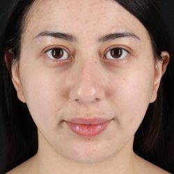 Rhinoplasty Before & After Patient #3159
