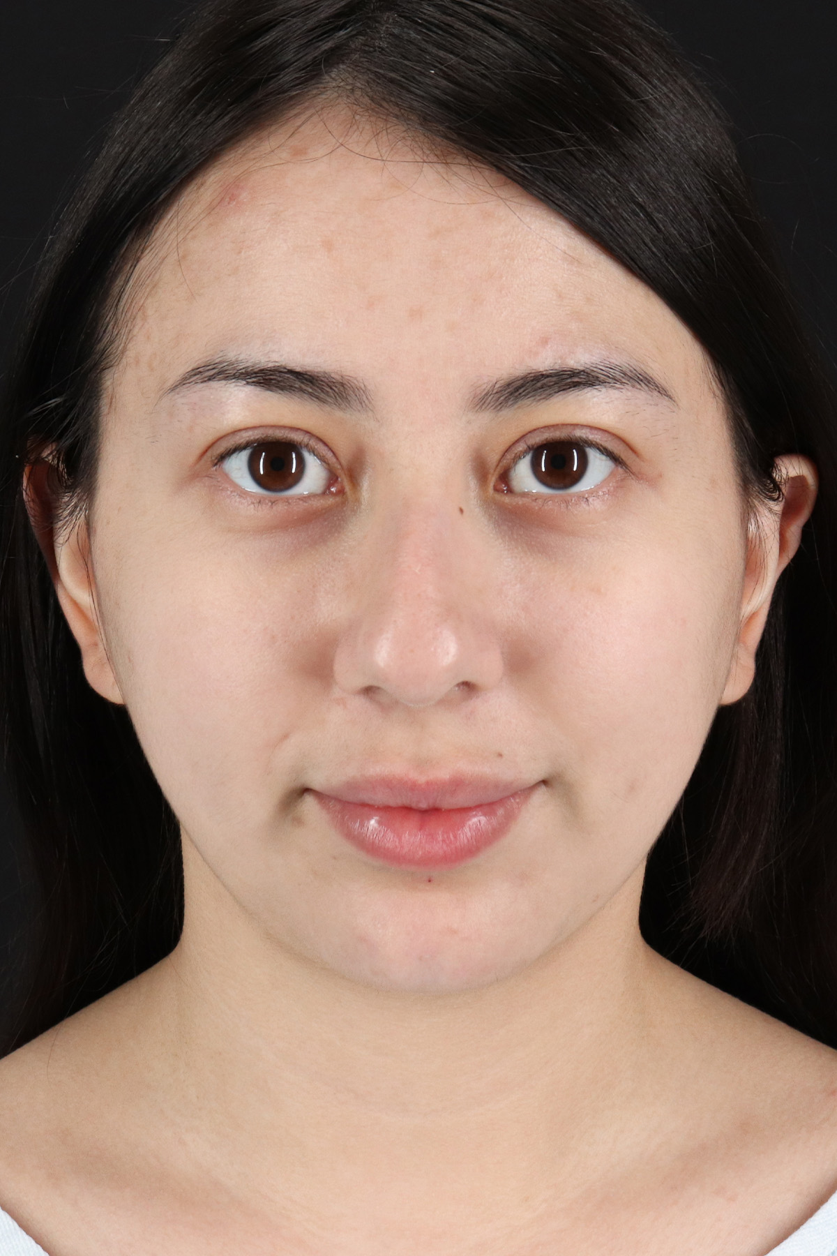 Rhinoplasty Before & After Patient #3159