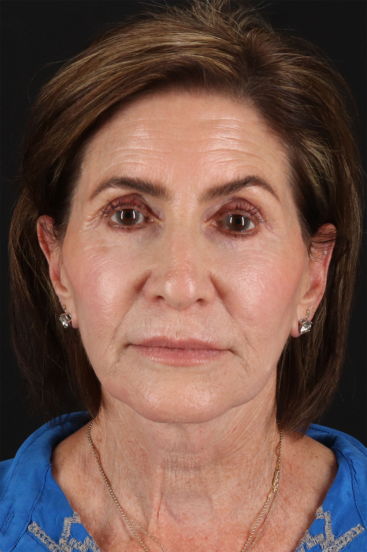 Co2 Laser Before & After Patient #3346