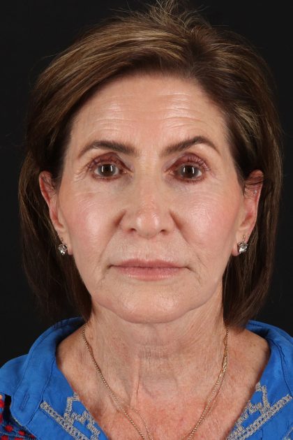Lip Lift Before & After Patient #2122