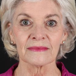 Upper Blepharoplasty Before & After Patient #5377