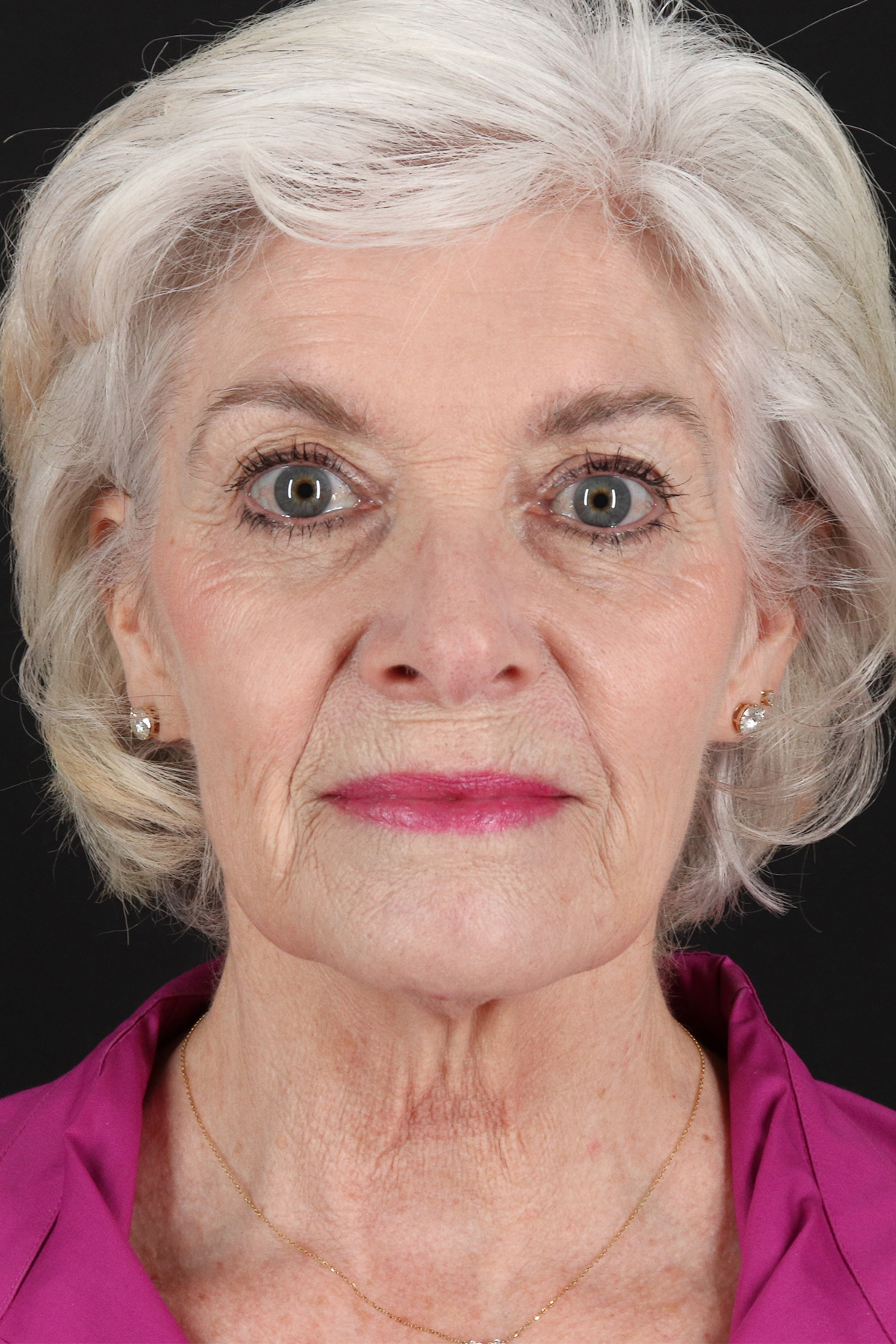 Upper Blepharoplasty Before & After Patient #5377