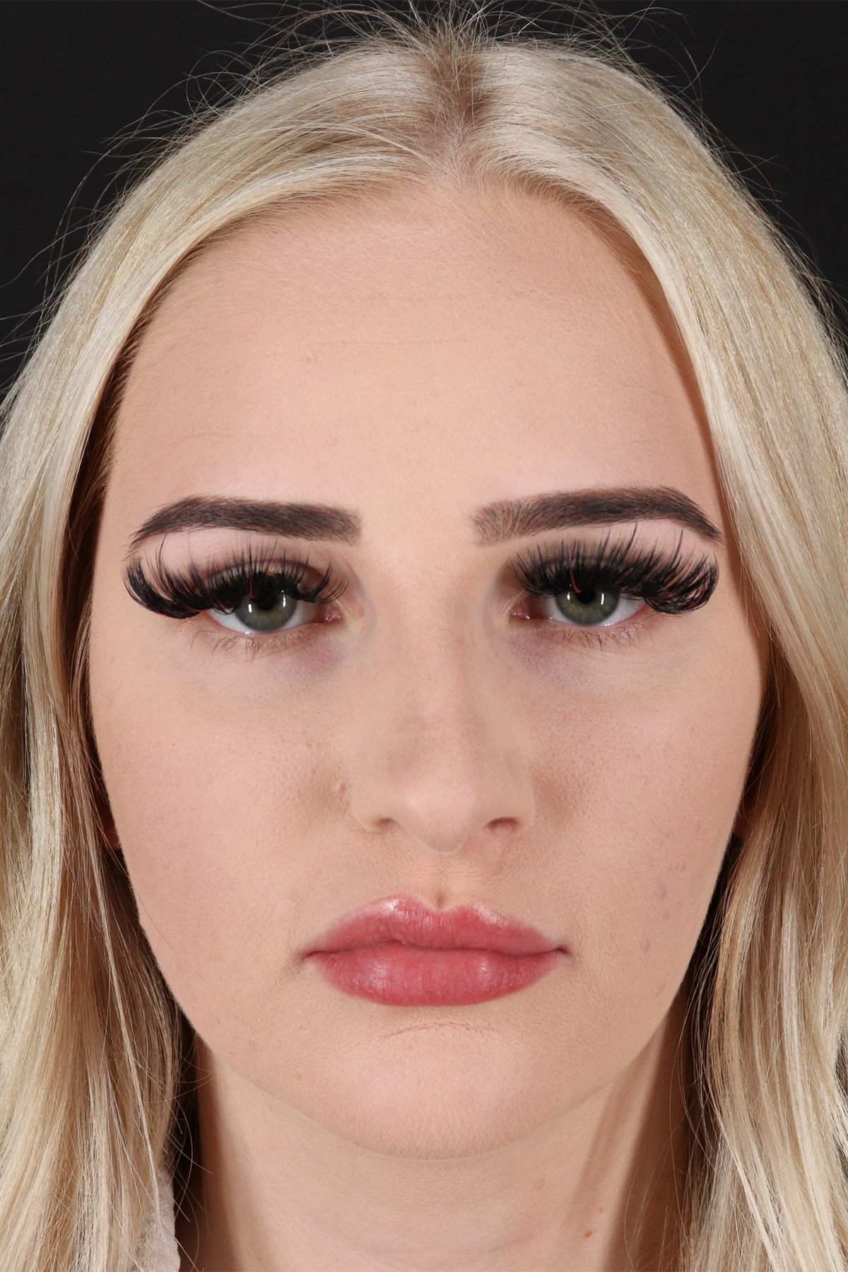 Rhinoplasty Before & After Patient #2807