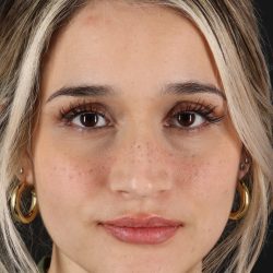 Rhinoplasty Before & After Patient #3258