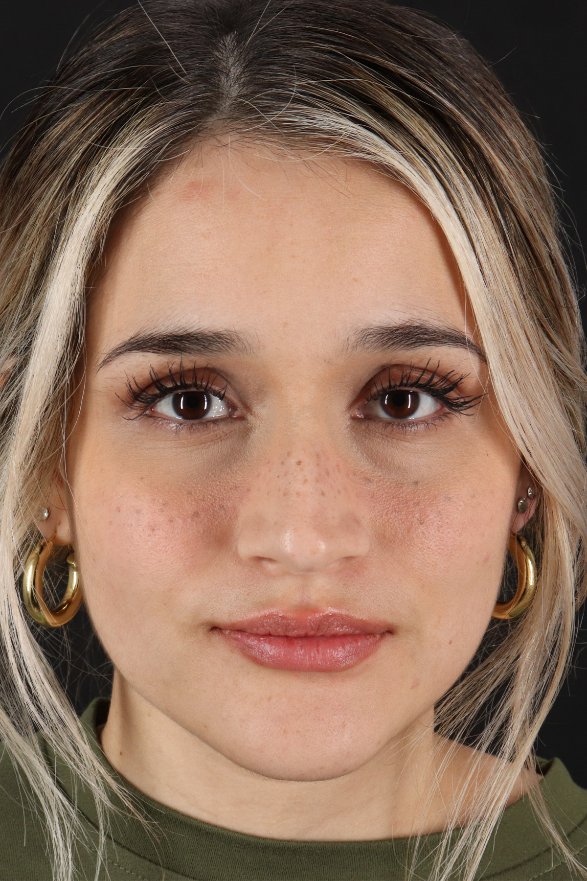 Rhinoplasty Before & After Patient #3258