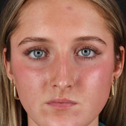 Liquid Rhinoplasty Before & After Patient #2221
