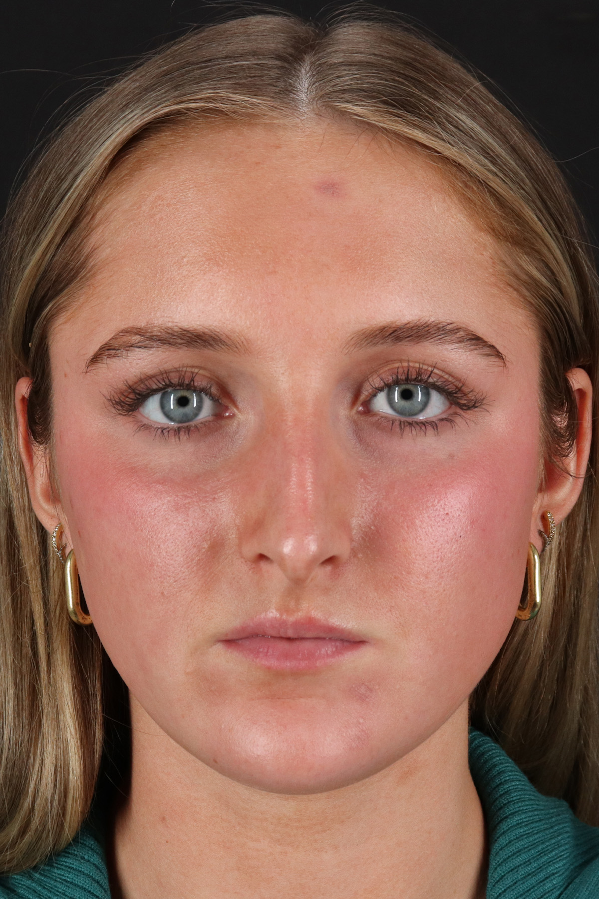 Liquid Rhinoplasty Before & After Patient #2221