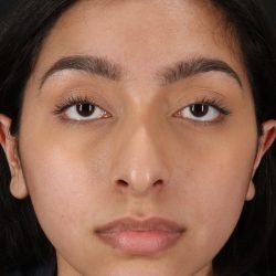 Chin Implant Before & After Patient #1637