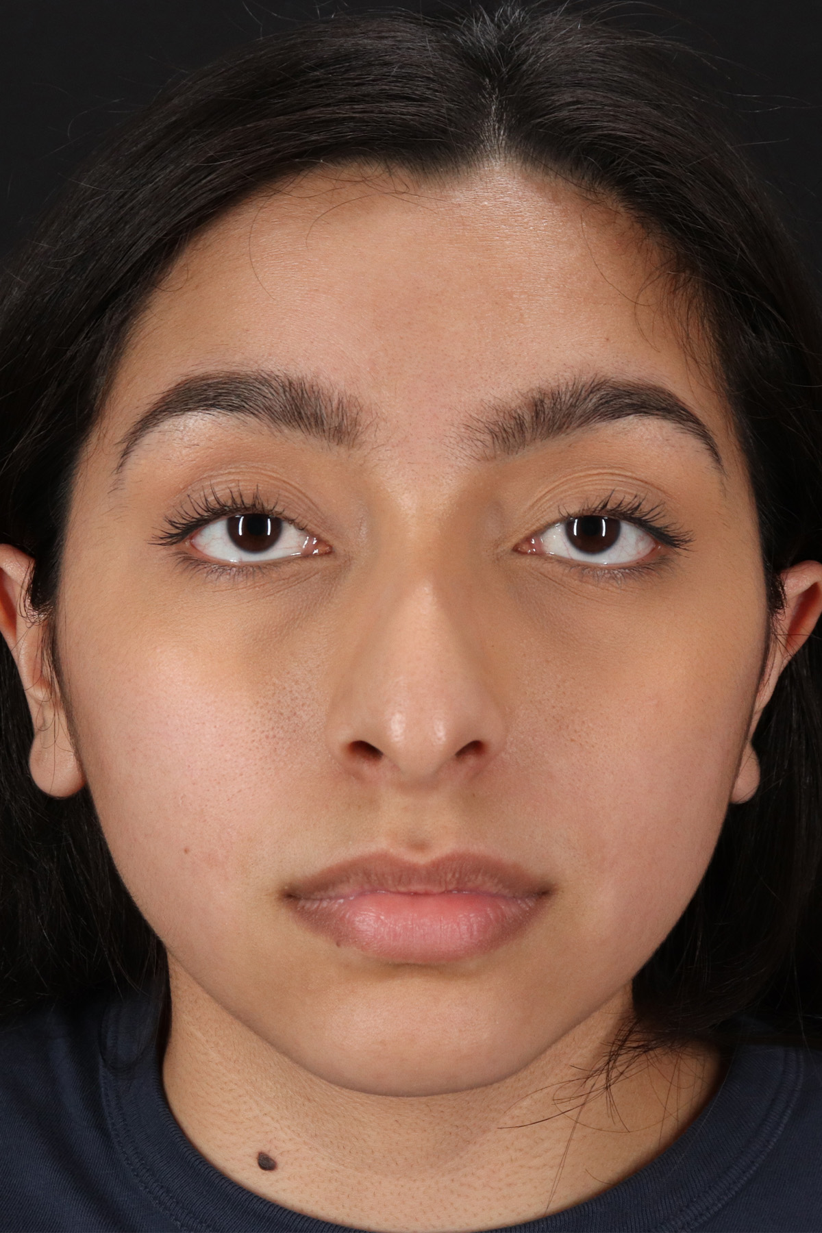 Chin Implant Before & After Patient #1637