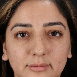 Rhinoplasty Before & After Patient #3115