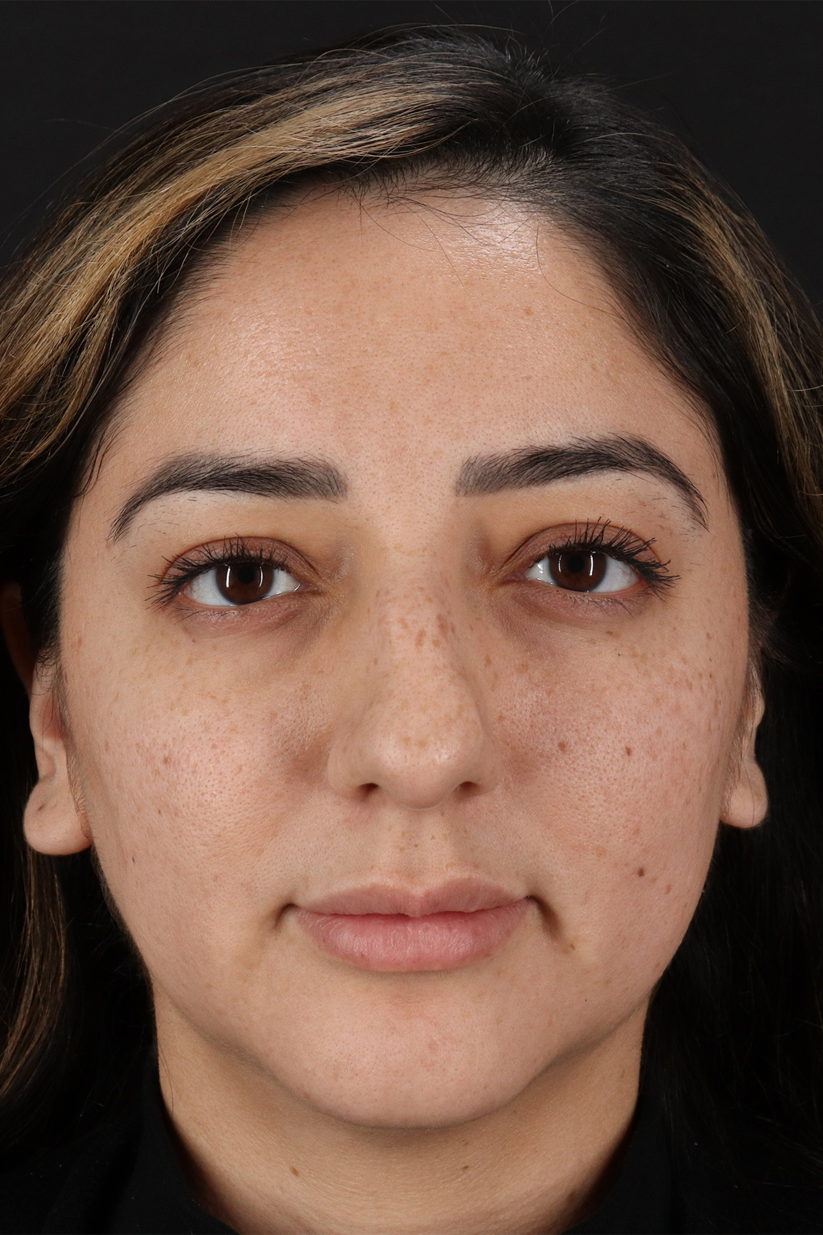 Rhinoplasty Before & After Patient #3115