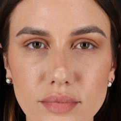 Rhinoplasty Before & After Patient #3137