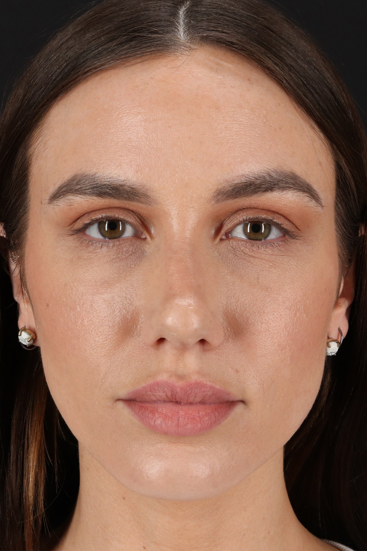 Rhinoplasty Before & After Patient #3137