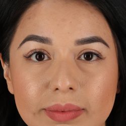 Chin Implant Before & After Patient #1626