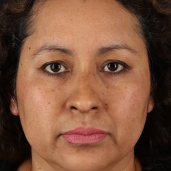 Rhinoplasty Before & After Patient #3225