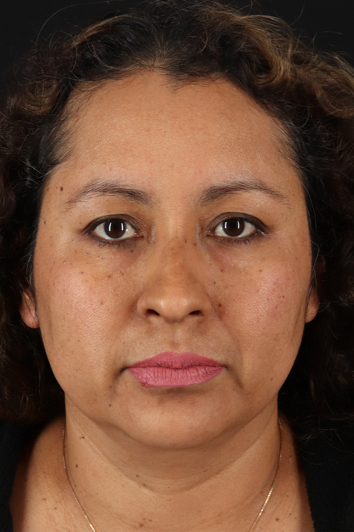 Rhinoplasty Before & After Patient #3225