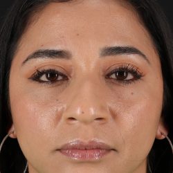 Rhinoplasty Before & After Patient #3082