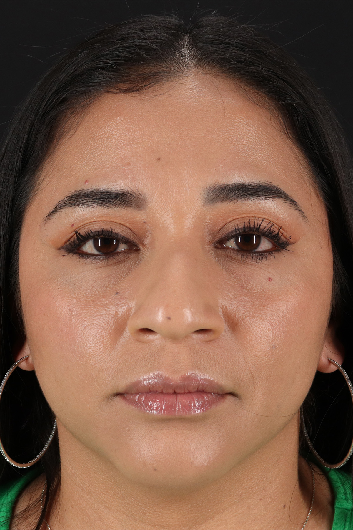 Rhinoplasty Before & After Patient #3082